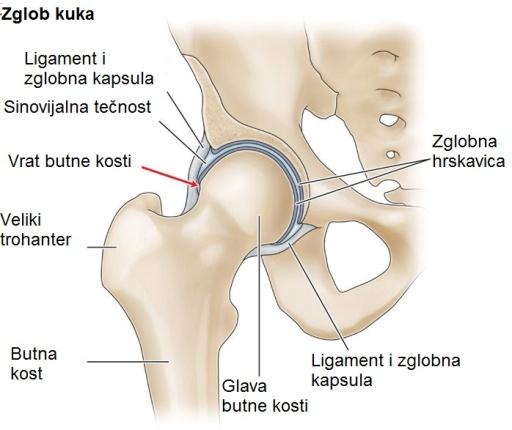 Artroza zgloba kuka - simptomi i liječenje