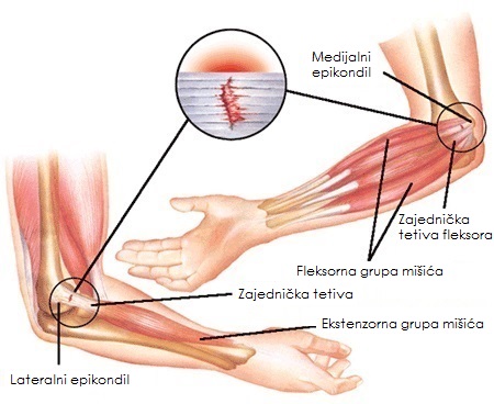 bol u laktu koji se proteže na zglobove prstiju