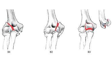 bol u koljenom zglobu stopala liječenje artroza zglobova liječenje koljena