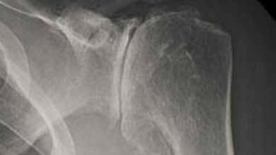 osteoartritis tretmana ramena protuupalna bol u zglobovima