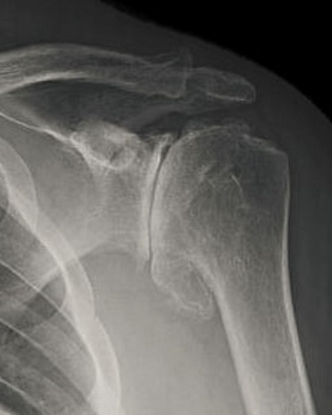 artroza ramenog zgloba kako ublažiti bol