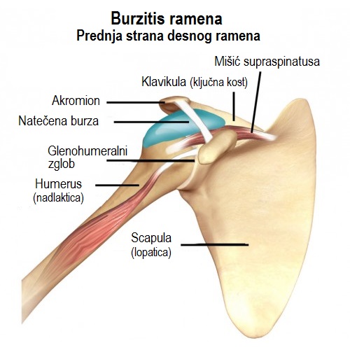 blokada za liječenje artroze ramena)