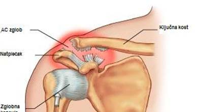 bol u ramenu joint ili živca