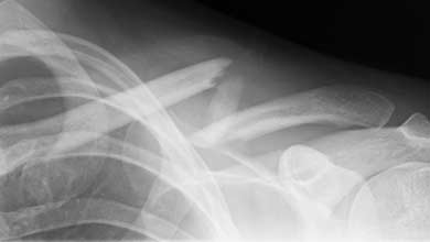 Prelom ključne kosti (klavikule) - rendgenski snimak