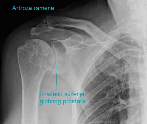 artroza ramena)