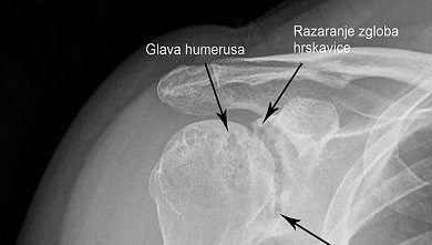 Reumatoidni artritis - rendgenski snimak