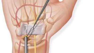 Lečenje sindroma karpalnog tunela: endoskopija