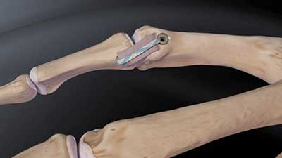 Zatezanje ulnarnog kolateralnog ligamenta palca