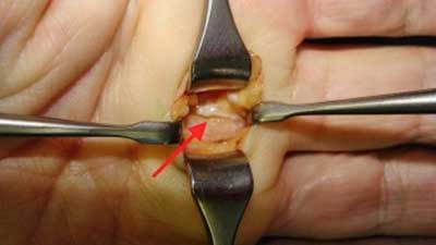 Operativno lečenje (operacija) škljocavog prsta