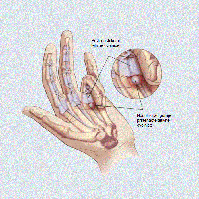Distorzija zglobova prstiju - vježbama poboljšajte stanje (video)