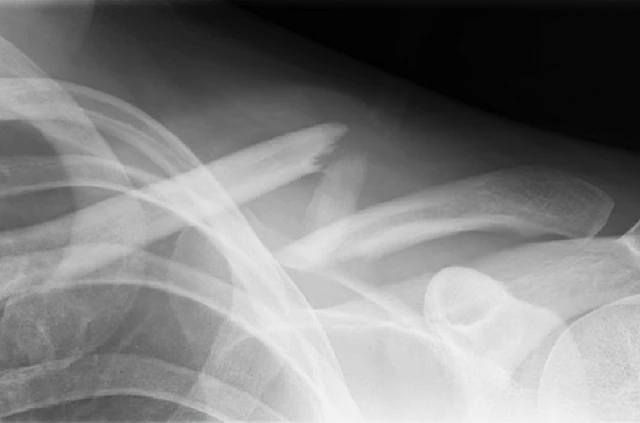 Prelom ključne kosti (klavikule), rendgenski snimak