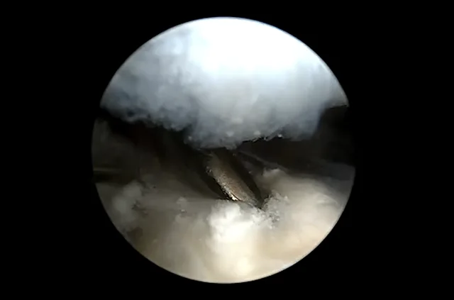 Artroskopija ramena – video